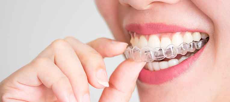 インビザライン®と従来のワイヤー矯正との違い